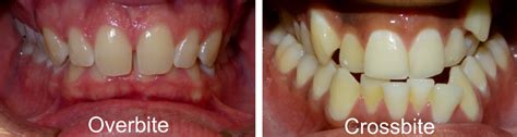 An overbite and an overjet can be easily confused. What is Crossbite: Symptoms, Diagnosis and Treatment