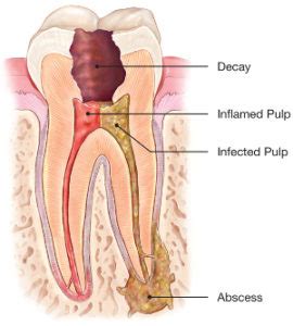 One of the main factors of how long it takes to complete a root canal is how infected. Root Canals: If my nerve is dead, why does... - Root ...