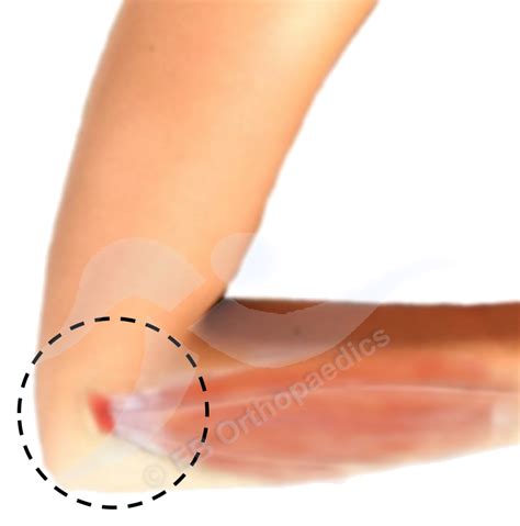 How do physicians diagnose tennis elbow? Orthopaedic & Trauma Surgeon - Elbow - Tennis elbow