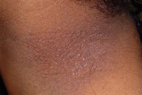 10. DERMATITIS O ECZEMAS