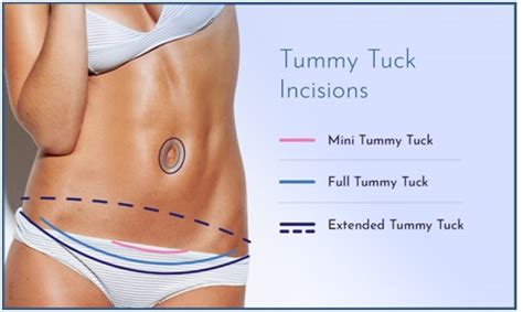 There are 11 pairs of external intercostal muscles. best tummy tuck surgeon in Udaipur