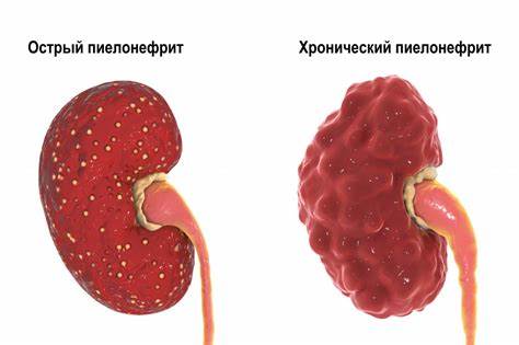 Пиелонефрит почек диет Пиелонефрит - причины, симптомы, диагностика и лечение Пиелонефрит - причины, симптомы, диагностика и лечение Пиелонефрит почек диет