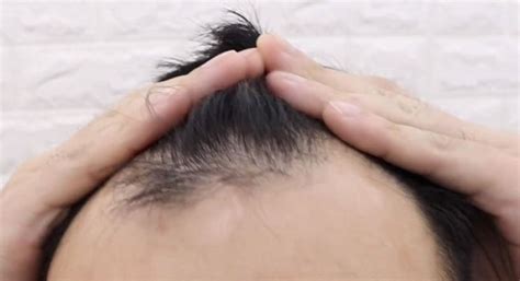 Chemotherapy also causes the hair to fall. Receding Hairline: Stages, Causes & Treatment | Hair Loss ...