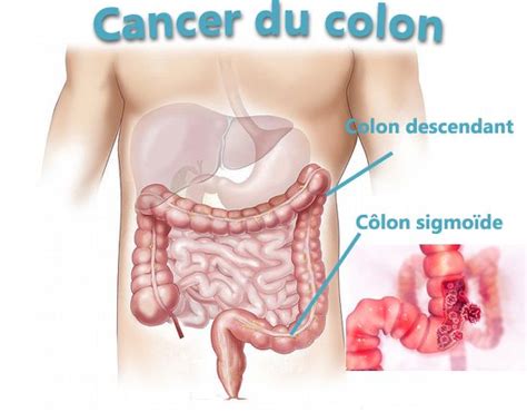 Le côlon ressemble à un gros tube d'une longueur de 1,50 m environ, disposé comme un cadre dans l'abdomen autres articles sur le sujet côlon : Le cancer du colon cancers tube digestif