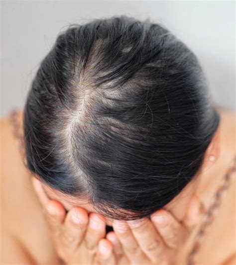 Diffuse hair loss is a medical condition in which hair density decreases all over the scalp due to more hair falling than is growing. Diffuse Hair Loss: Causes, Signs and Treatment Options