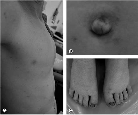 Another common manifestation is the short, flattened bridge of the nose of the child. Oral Findings and Dental Treatment in a Child with Williams-Beuren Syndrome