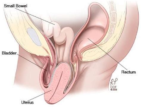 Rahim turun (prolapsus uteri) atau peranakan turun adalah kondisi rahim turun ke vagina. Peranakan Jatuh & Turun, Ini Lapan Cara Rawatan Untuk ...