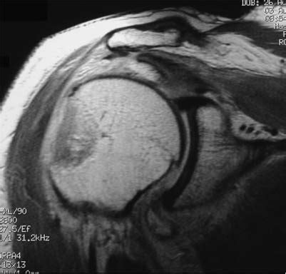 Isolated Tuberosity Fractures | Musculoskeletal Key
