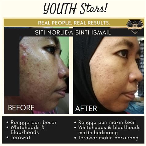 Apjii mengungkap pengguna paling banyak terhubung setiap harinya dengan internet lewat smartphone (93,9%). TESTIMONI YOUTH SKINCARE: PEMENANG PERTANDINGAN YOUTH STAR ...