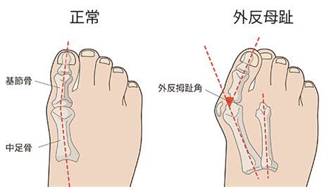 【橋本 慶太】変形性足関節症（へんけいせいそくかんせつ ...