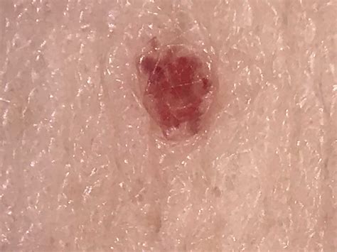 The size of the tumor may grow along with age and the angioma will occur on any part of the body except mucous membrane. What is Cherry Angioma? - Dr. Maksym BreslavetsDr. Maksym ...
