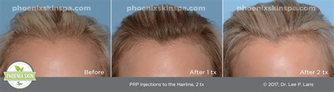 Do this twice a week for quicker, stronger, healthier hair regrowth. Platelet Rich Plasma for Hair Loss - Phoenix Skin Spa