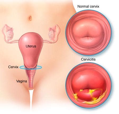 Risk factors for an abnormal pap include hpv, smoking, medications, and a a pap smear is a simple, quick, and essentially painless screening test (procedure) for cancer or precancer of the uterine cervix. Cervitis, Cervix Pain Specialist · Pelvic Doctors · Dr ...