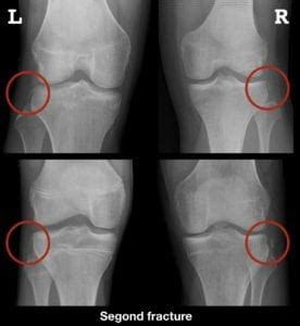 Condylar fracture, which may be treated by. Tibial plateau Archives • Life in the Fast Lane • LITFL ...