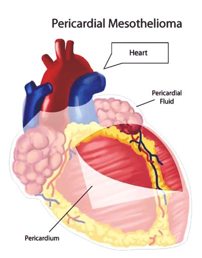 Pericardial Mesothelioma