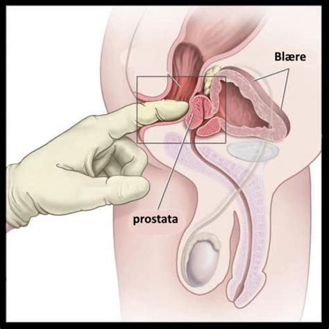 The primary purpose of prostate massagers is to massage a man's prostate. prostata massage