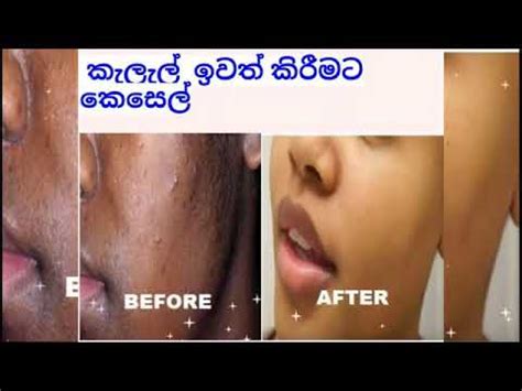 Check out how to remove dark spots on lips naturally. How to remove dark spots on face fast at home in Sinhala ...