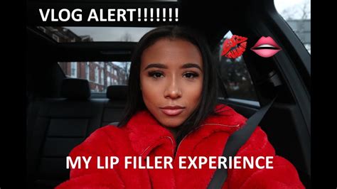 This is natural and can be reversed if necessary, using product that dissolves it. I GOT LIP FILLERS ... VLOG!!! - YouTube