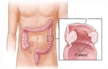 Benjolan atau penebalan dapat menjadi tanda awal atau akhir kanker dan harus dilaporkan ke dokter. 7 Tanda-tanda awal kanser usus yang perlu diberi perhatian ...