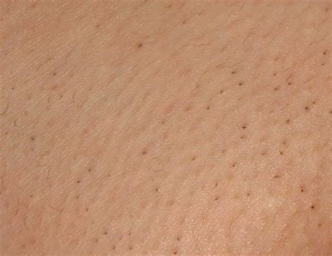 However, several studies have confirmed the development of. Hair Shedding and Pepperspots