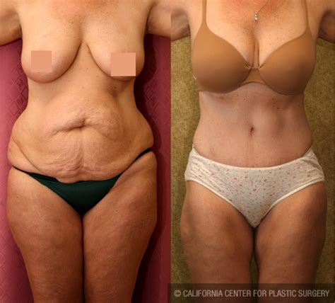 Maybe you would like to learn more about one of these? Patient #5821 Tummy Tuck Medium Size Before and After ...