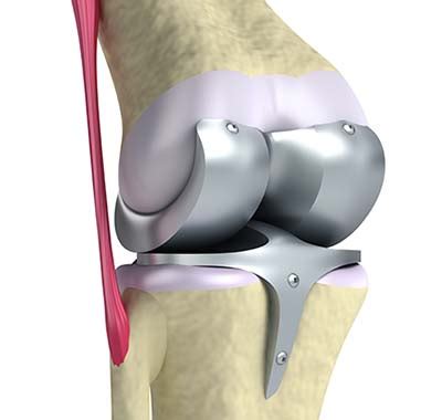 Selon l'état des ligaments, il existe des prothèses de stabilité variable le remplacement complet de l'articulation du genou est envisagé lorsque l'articulation est tellement abîmée que le patient continue à présenter des. Arthrose quand poser une prothèse du genou ? Prothèse ...