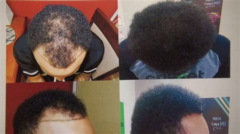 3 weeks ago 3 min read. San Francisco Hair Transplant Result Curly Black African ...