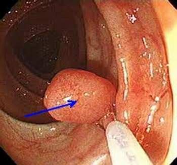 Jun 23, 2021 · bắc giang: Bệnh polyp dạ dày là gì?