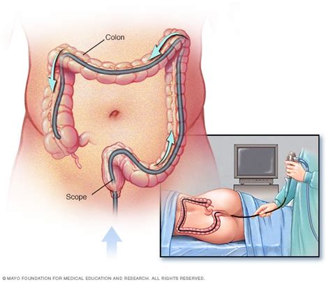 Colon cancer is the presence of cancerous tumors in the colon or rectum. Diagnosis - Colon cancer - Mayo Clinic