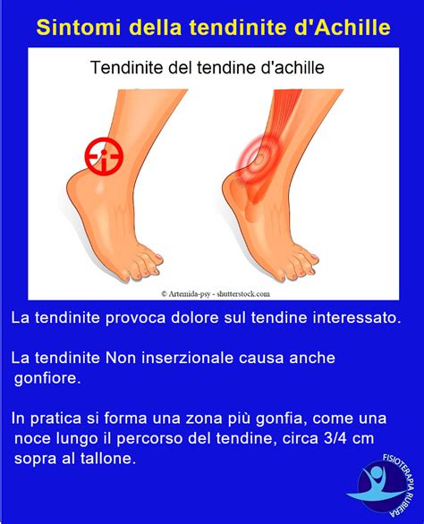 Quando parliamo di trattamento di tendiniti e tendinopatie , non possiamo non pensare al trattamento con onde d'urto tendine d'achille, il tendine più grande, e robusto che abbiamo. Tendinite al Tendine d'Achille: le Reali Cause e i Sintomi