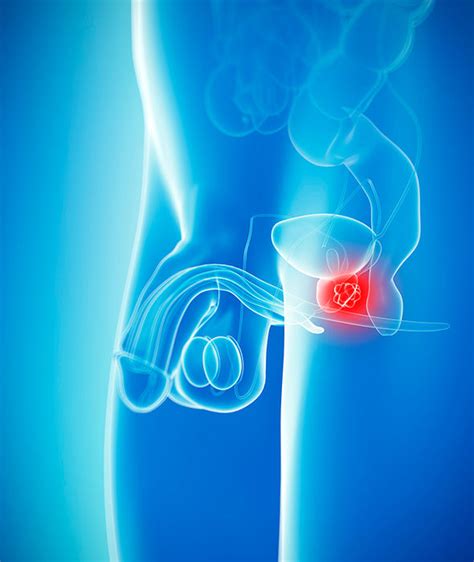 According to the nhs, these include: Prostate cancer symptoms and signs: Look for this when you ...