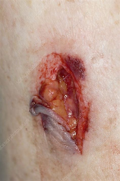 Flap laceration on the arm - Stock Image - C008/5736 - Science Photo ...