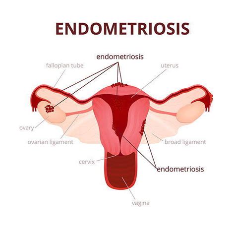 Perché la diagnosi richiede tanto tempo. Endometriosi: sintomi, cause, persone a rischio, rimedi ed ...