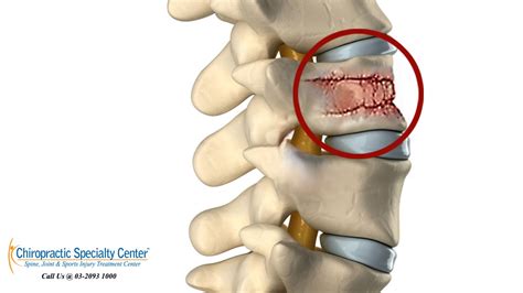 Simes, singapore malay eye study; Diagnosis of Low Back Pain in Malaysia