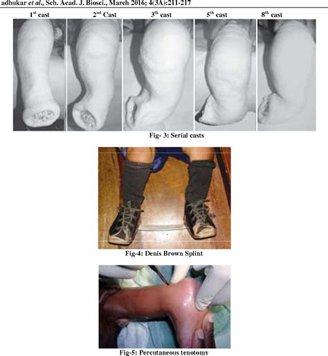 Congenital talipes equniovarus (ctev) atau kaki pengkor atau clubfoot adalah suatu cacat lahir yaitu kaki terpelintir dari bentuk atau posisi normal. Table 1 from Treatment of idiopathic congenital talipes ...