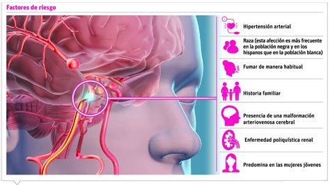 Cuando se presenta un aneurisma en un vaso sanguíneo del cerebro, se denomina. Aneurisma Cerebral - Medicos Ticos Tratan Aneurisma Cerebral Con Cirugia No Invasiva La Nacion ...