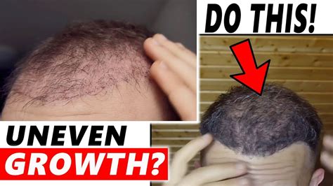 Mar 8, 2011 #1 lately i have noticed my hair is growing unevenly. Uneven Growth after Hair Transplant? DO THIS!! - YouTube