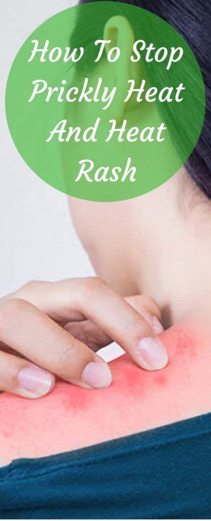 How to treat and prevent it. How To Stop Prickly Heat And Heat Rash #picklyheat #heatrash | Heat rash, Rashes remedies, Itchy ...