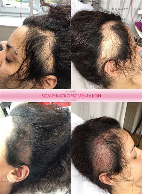 Alopecia areata is a condition where patches of hair loss develop, usually on the head. Alopecia Areata Behandlung mit Permanent Make-up - beauty art