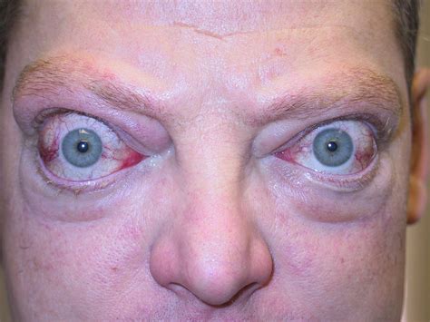 Don't let that stop you from talking with your doctor. Orbital Reconstruction Surgery, Proptosis, Exophthalmos ...