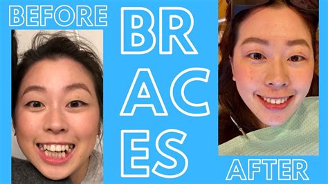 Break off some wax from getting braces could either be the most daunting or rewarding experience. My Braces Journey: Getting them on, off, pain, routine and ...