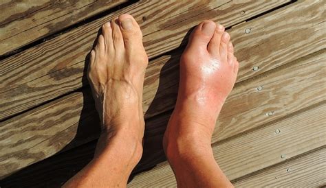 And causes of foot pain can range from injury and inflammation to structural issues and maladaptations. How to Deal With the Swelling of the Top of Your Foot | MD ...