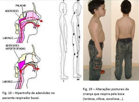 Esta doença é transmitida de forma hereditária e é autossômica e dominante. Os males da chupeta e como ela pode comprometer seu filho ...