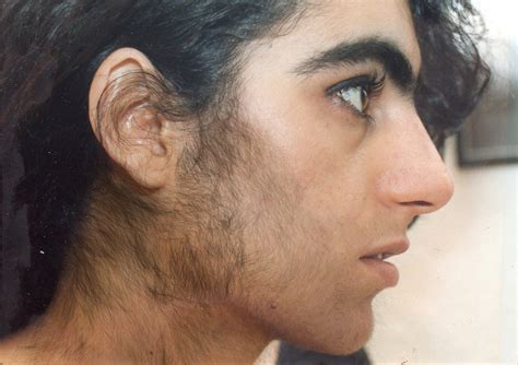 The type of hypertrichosis specific to women is. Hirsutism increased hair growth in women | Women's Health ...