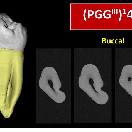 There is a large cervical resorptive defect on the buccal aspect of the distal root extending into the furcation. Application of the new coding system to describe teeth ...