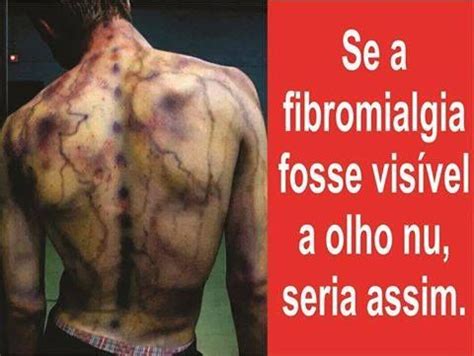 Esses pontos de gatilho podem distorcer sua percepção e senso de equilíbrio, fazendo com que você deixe cair coisas ou tropeçar e tropeçar nas coisas. Fibromialgia | Sintomas da fibromialgia, Fibromialgia ...