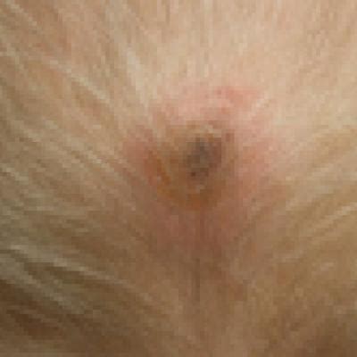 Hair loss in cancer patients is typically caused by the cancer treatment, not the disease itself. Lung Cancer-Associated Scalp Hair Loss: A Rare Cause of ...