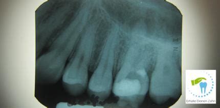 Kann ein zahn trotz einnahme von blutverdünnern gezogen werden? Muss ein Zahn nach einer Perforation gezogen werden? - ZWP ...
