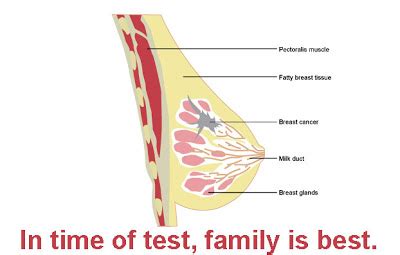 Several breast lumps are not cancer, but are strongly associated with an increased risk of cancer. Breast Cancer Pictures: Breast Cancer Lumps