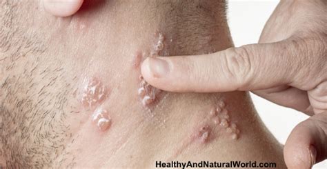 In the u.s., manuka honey is approved by the food and drug administration (fda) for use in wound dressings. How To Treat Shingles With Manuka and Clover Honey
